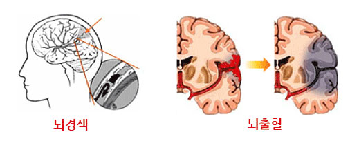 뇌경색, 뇌출혈 관련 이미지